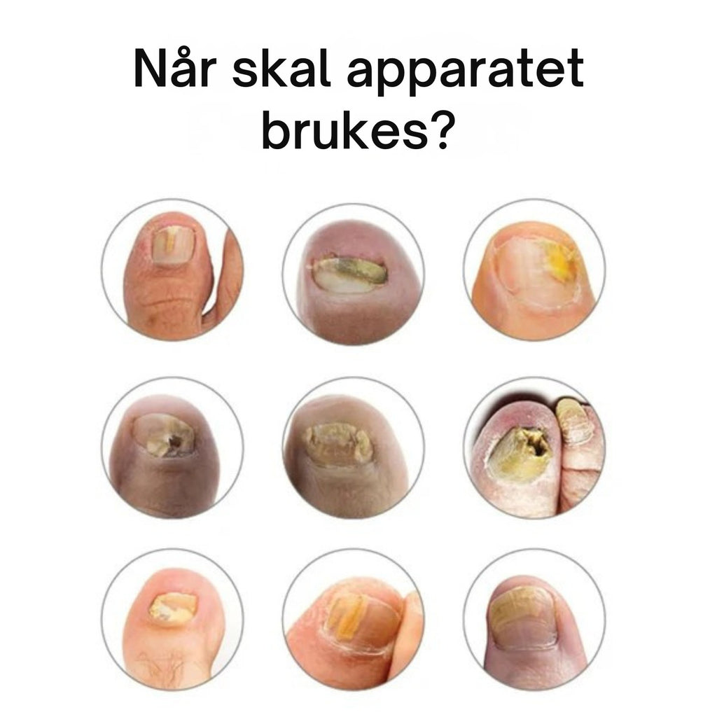 Nordist™ soppbehandlingsenhet for negler
