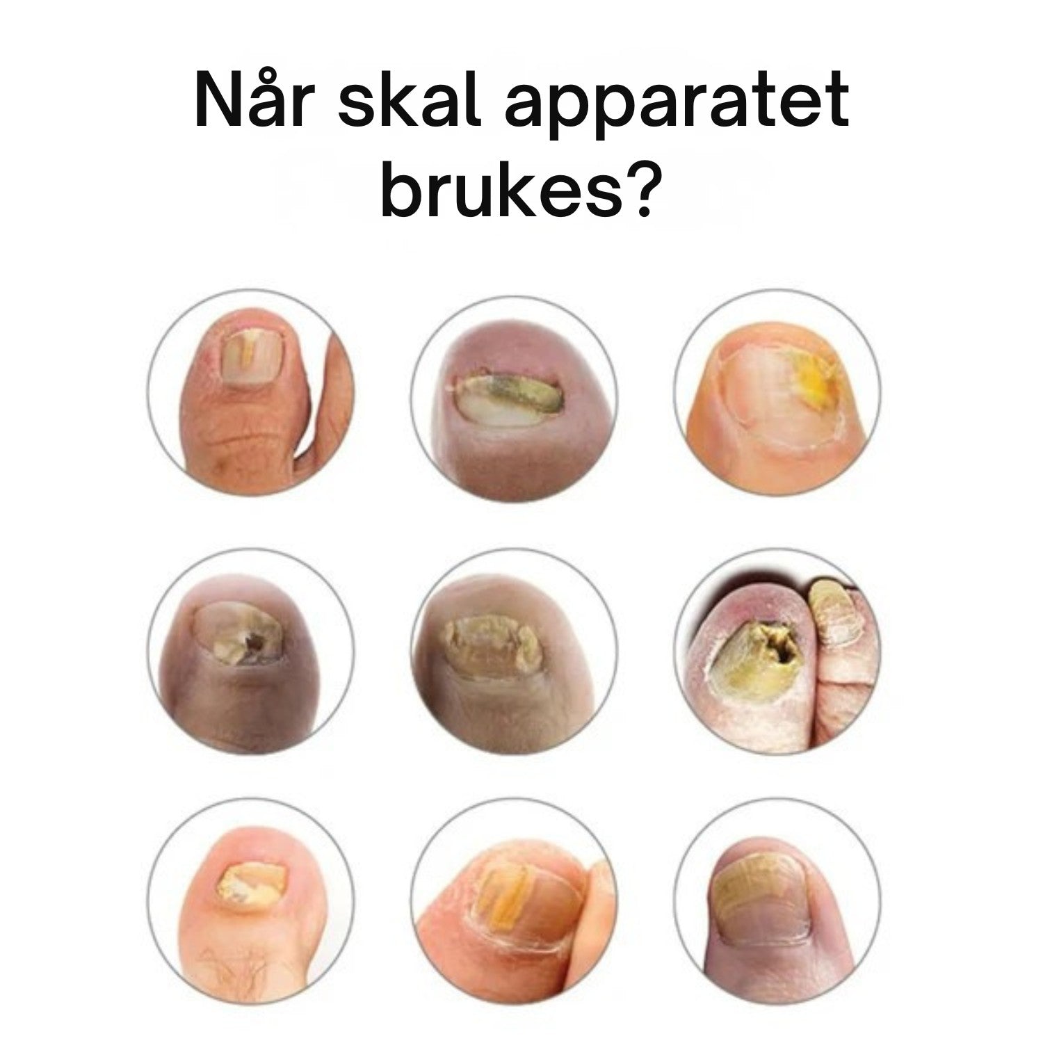 Nordist™ soppbehandlingsenhet for negler