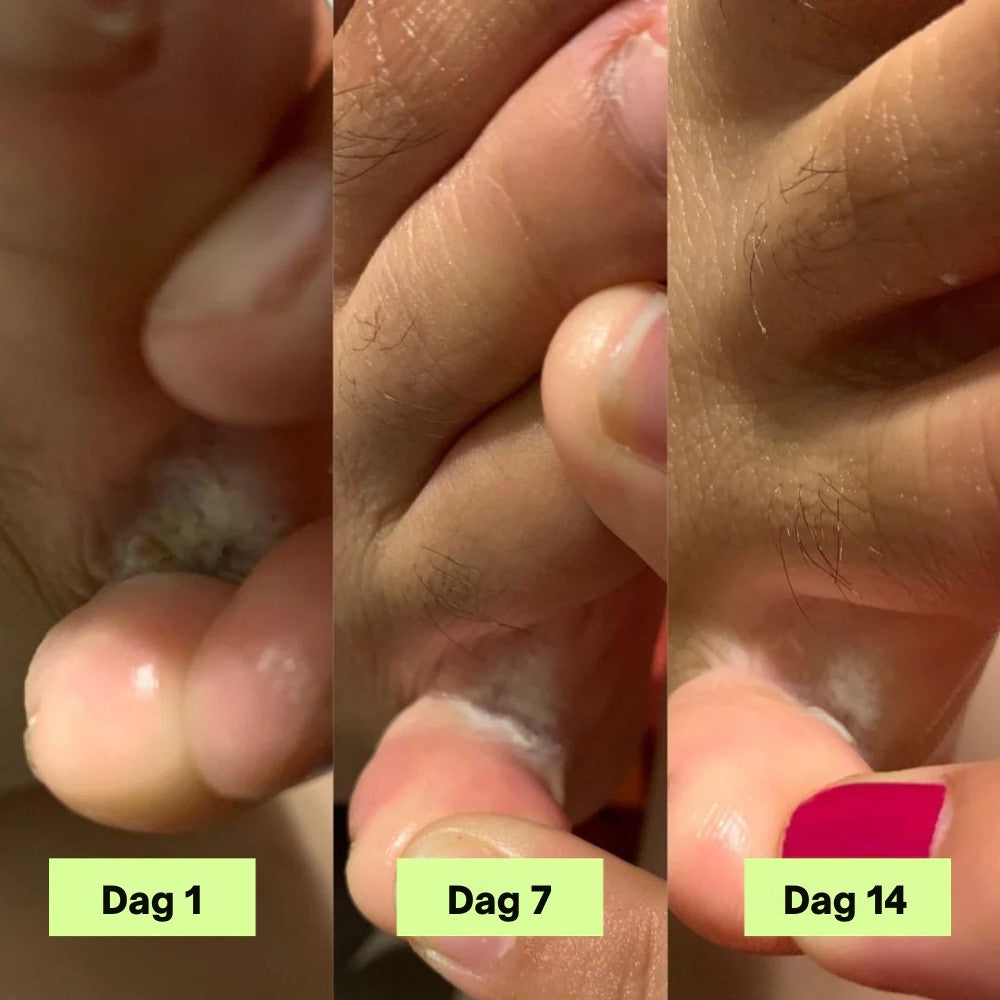 Nordist® Anti-Sopp Såpebar