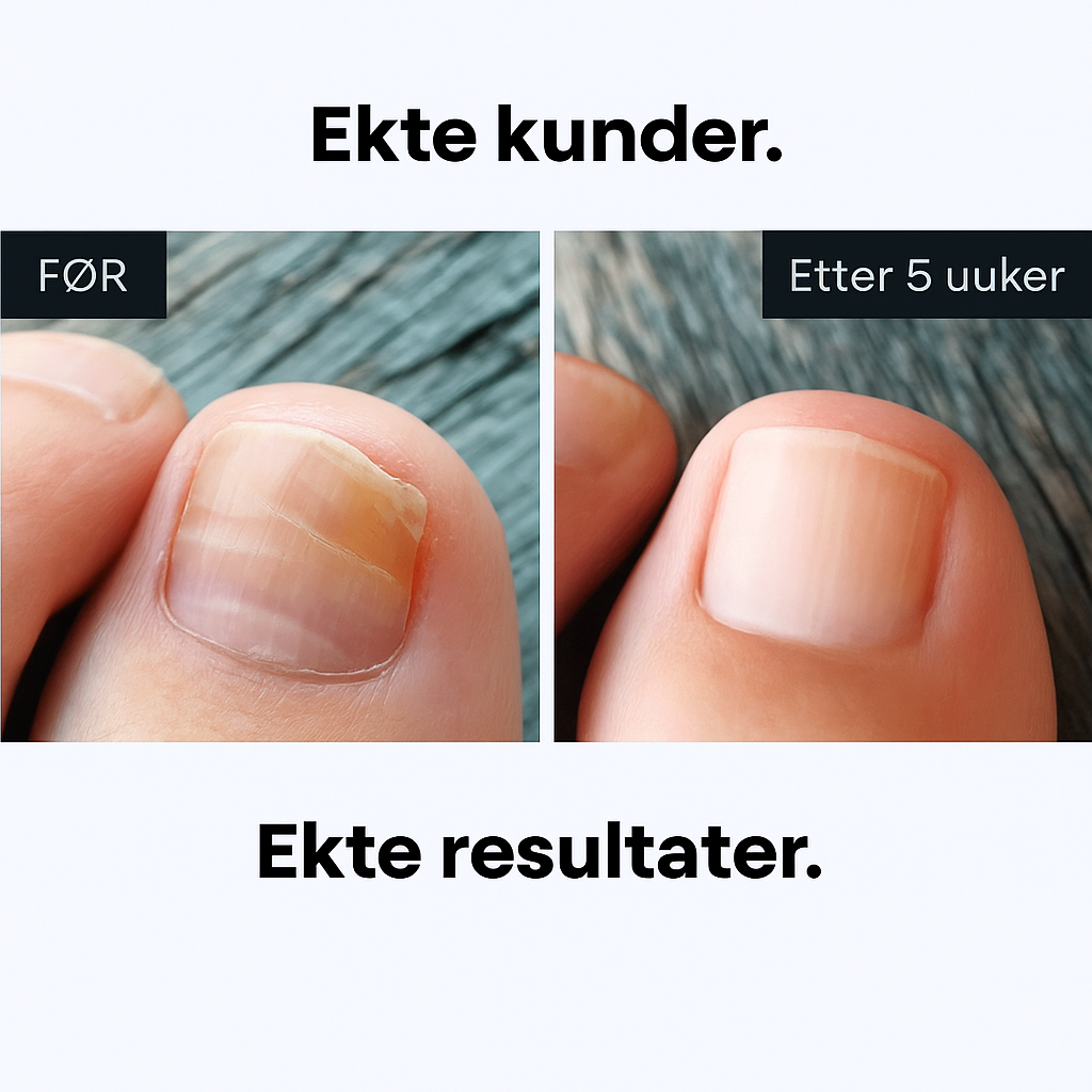 Før og etter neglesoppbehandling