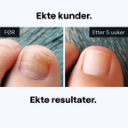 Før og etter neglesoppbehandling