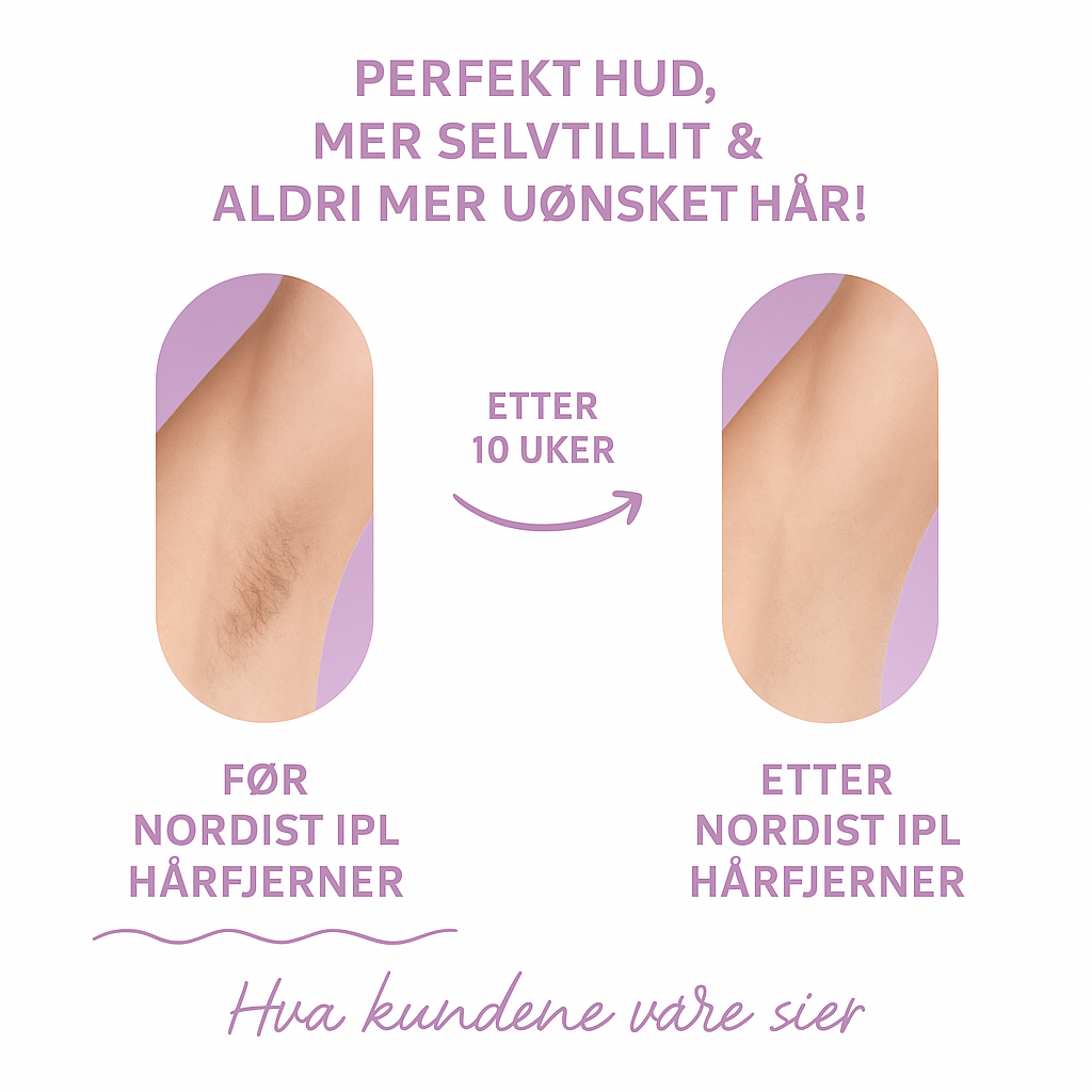 Nordist IPL før og etter